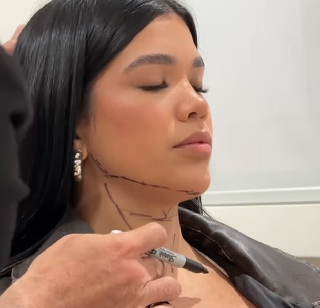 Woman with markings on her neck for procedure.
