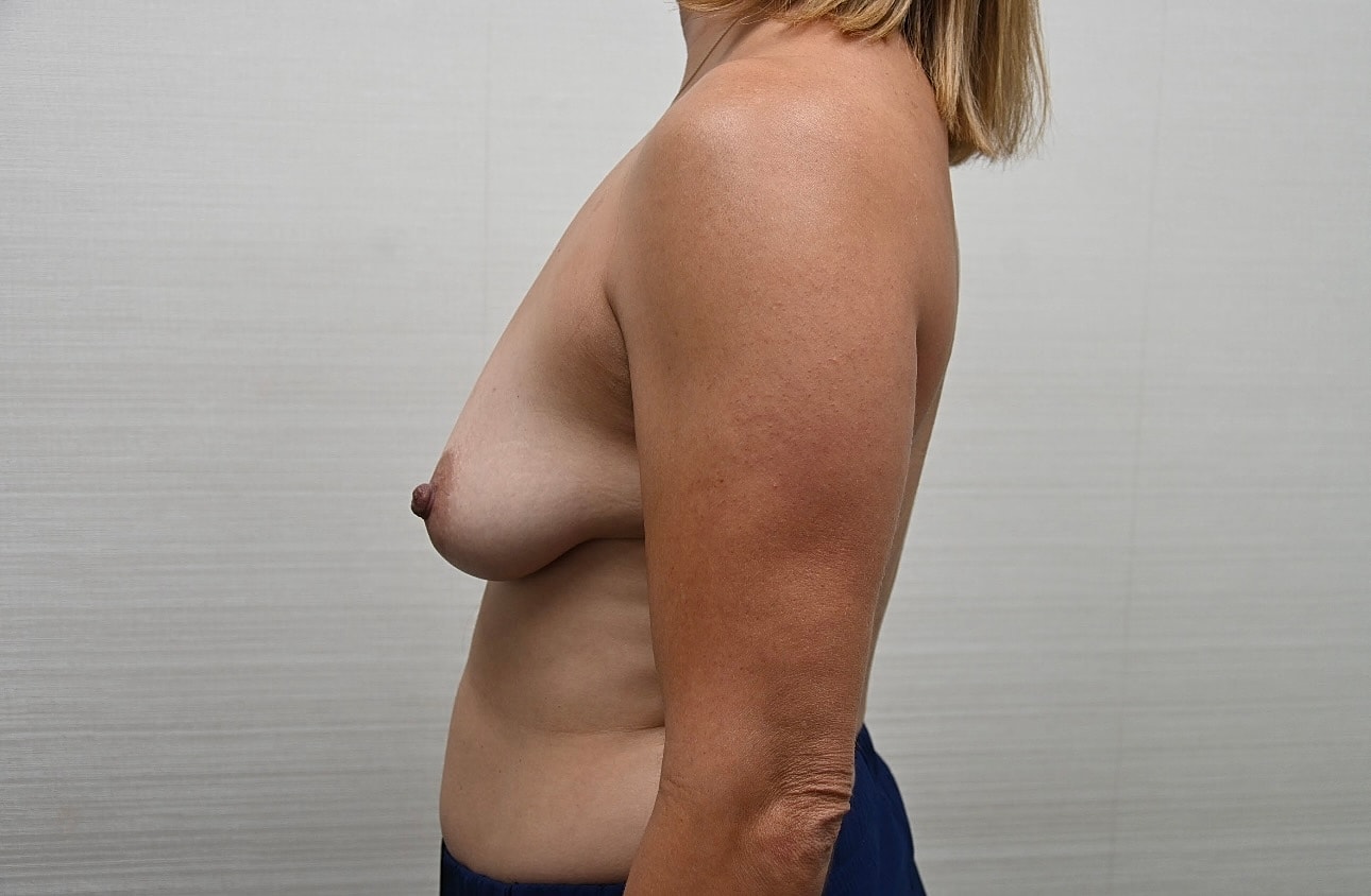 Mastopexia Con Implantes Before & After