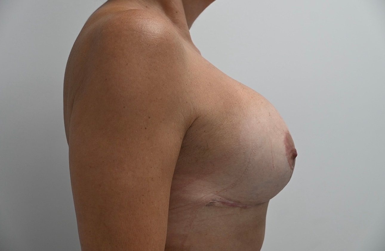 Mastopexia Con Implantes Before & After