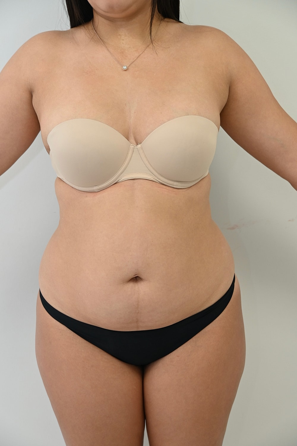 Abdominoplastia Before & After