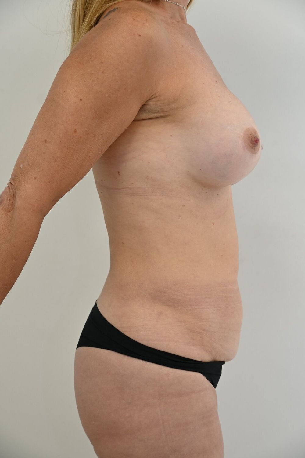 Abdominoplastia Before & After