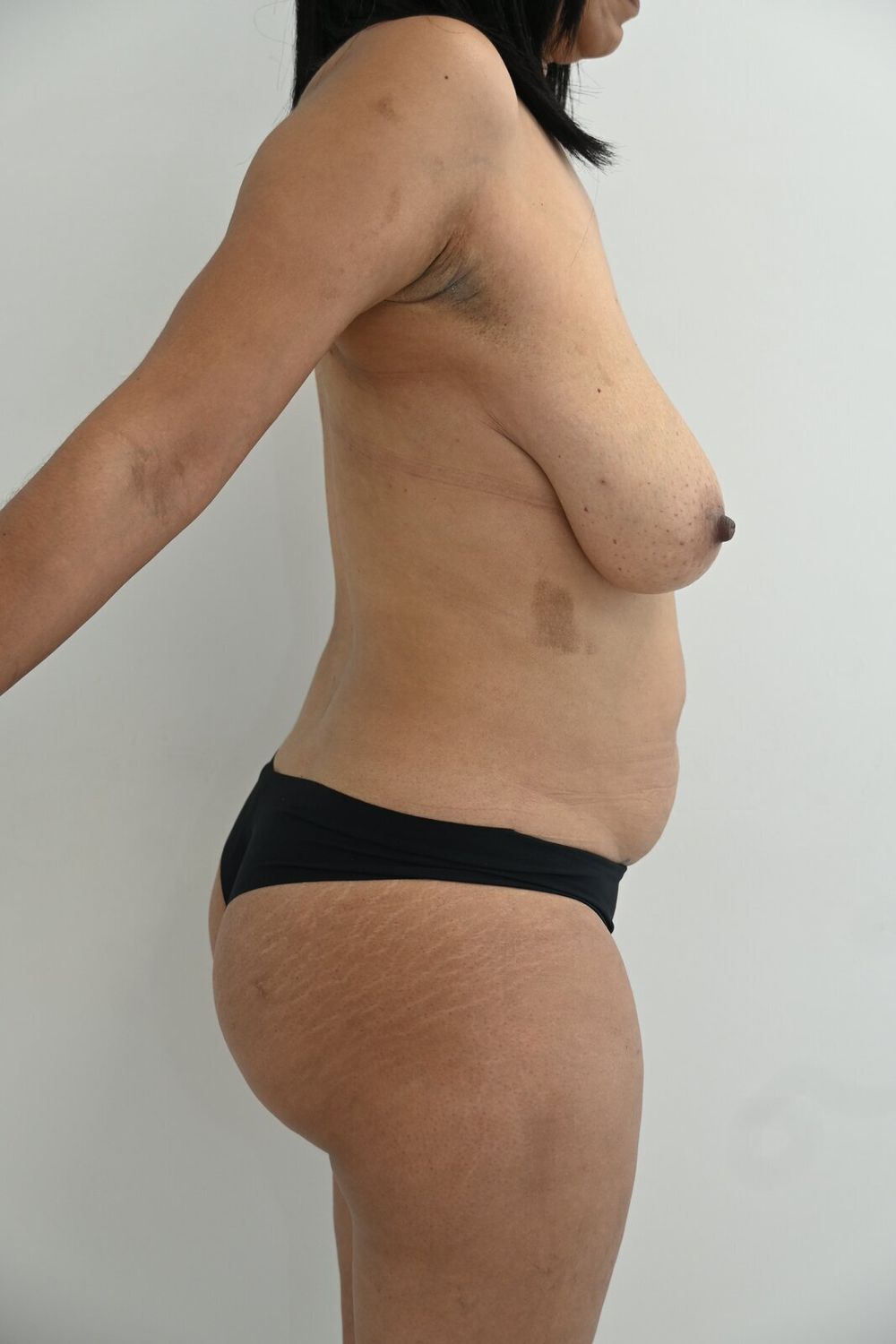Abdominoplastia Before & After