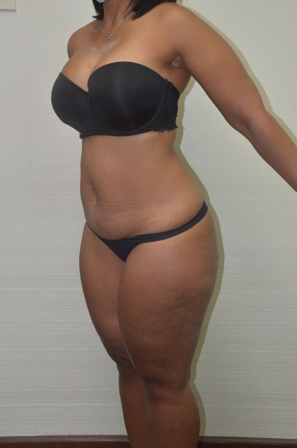 Abdominoplastia Before & After