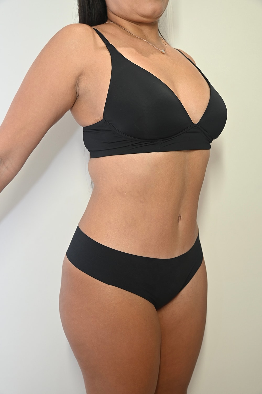 Abdominoplastia Before & After