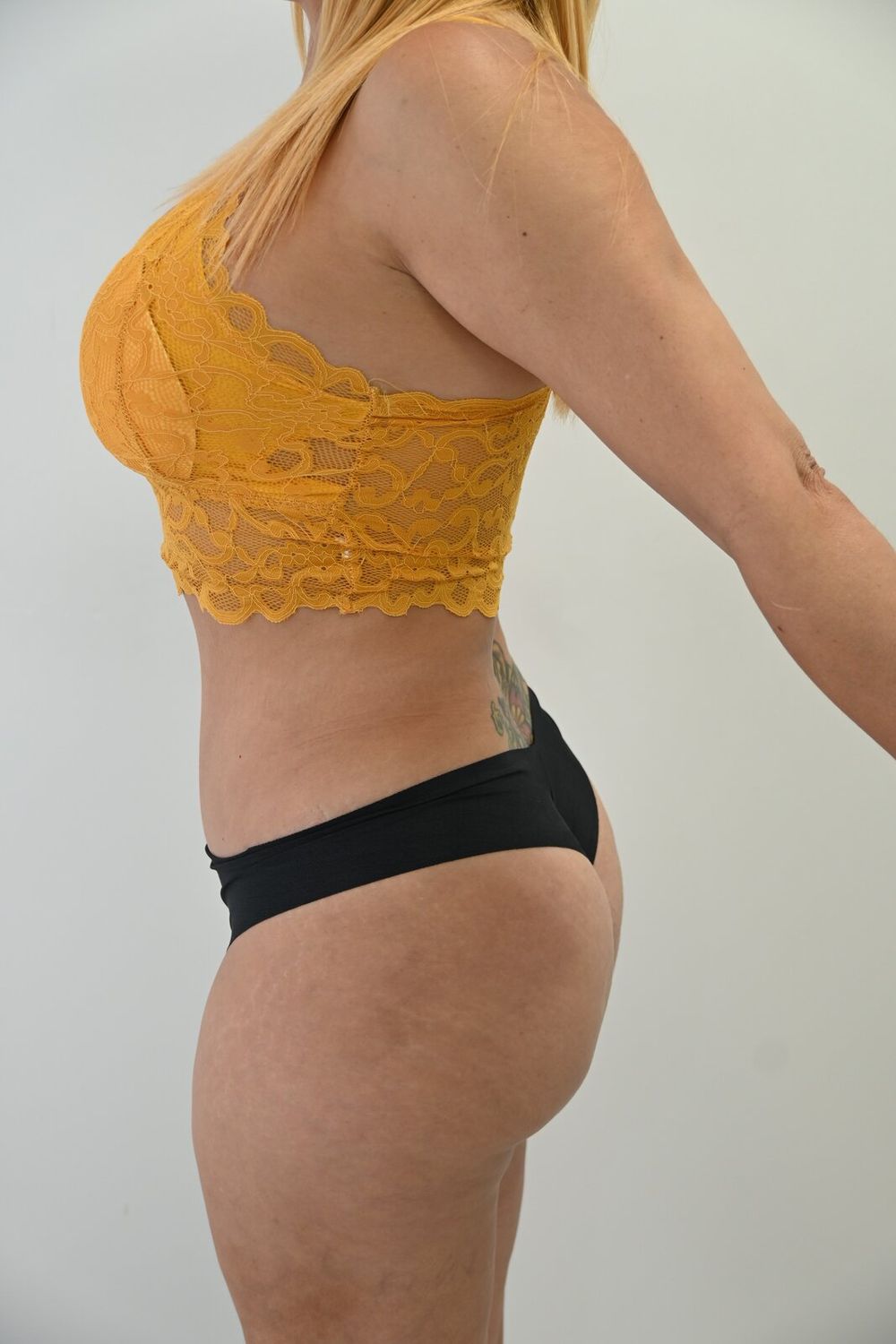 Abdominoplastia Before & After