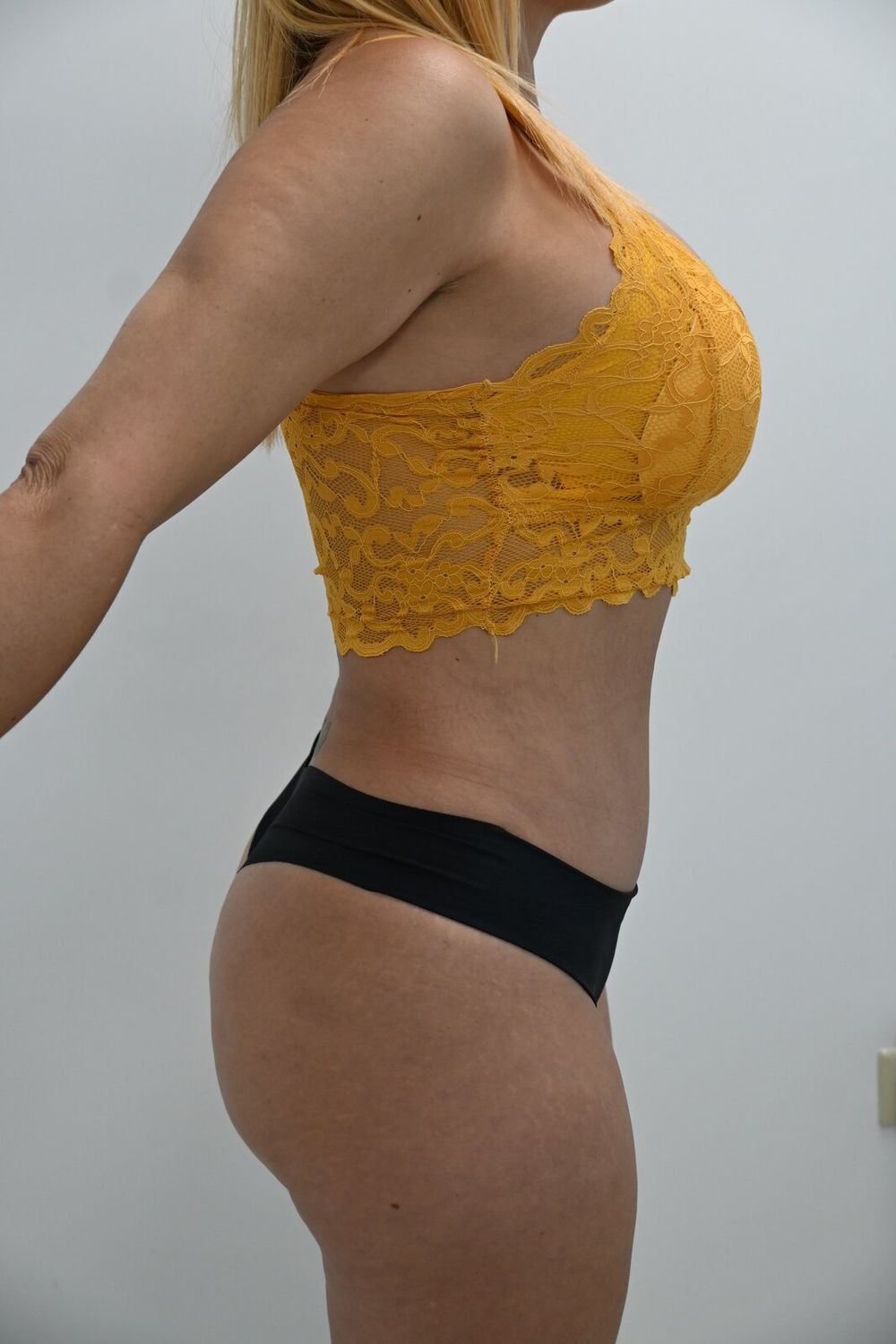 Abdominoplastia Before & After