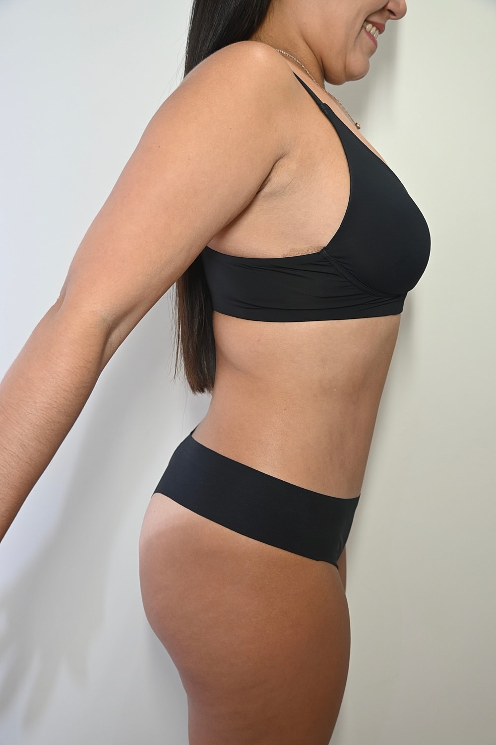 Abdominoplastia Before & After