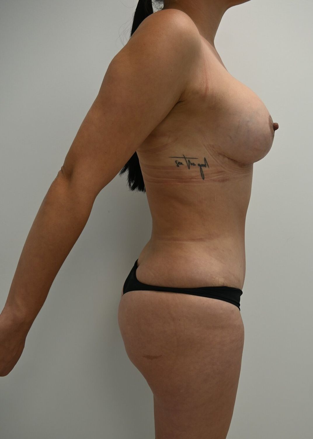 Abdominoplastia Before & After