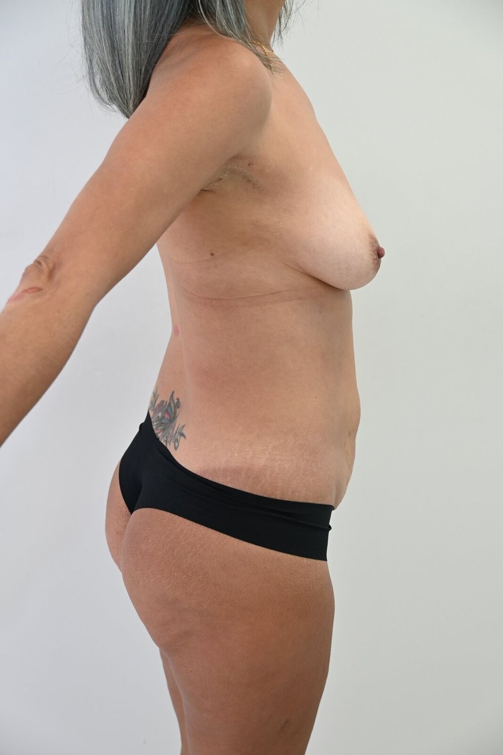 Abdominoplastia Before & After