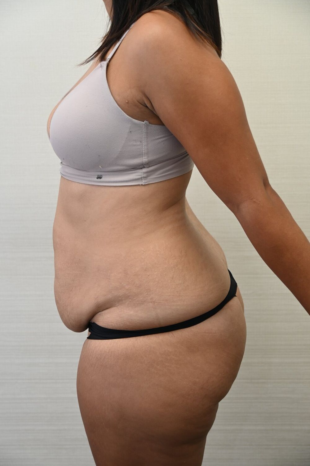Abdominoplastia Before & After