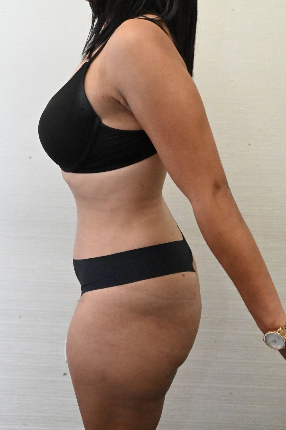 Abdominoplastia Before & After