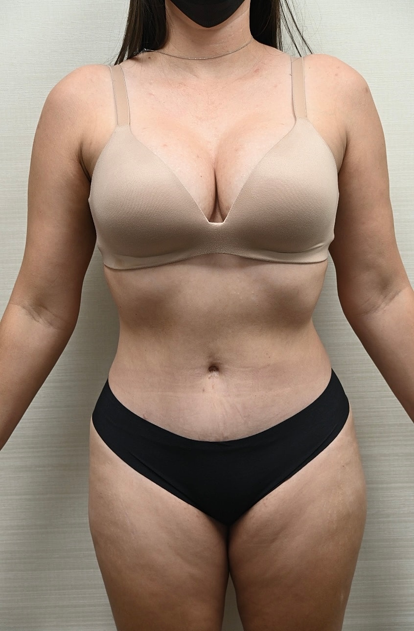 Abdominoplastia Before & After