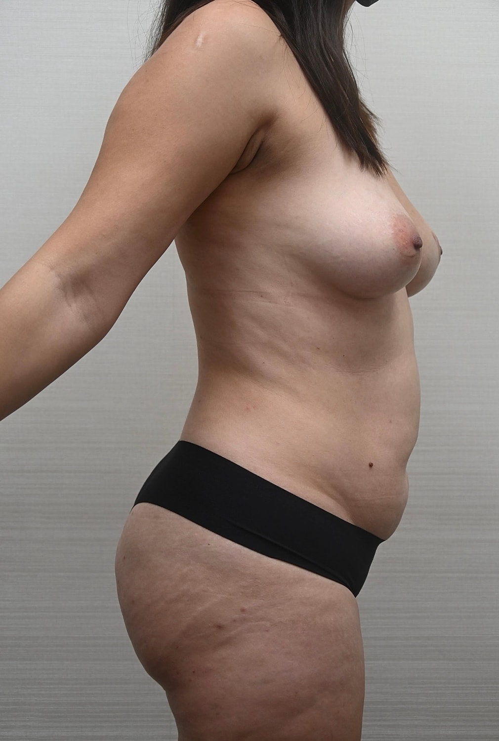 Abdominoplastia Before & After