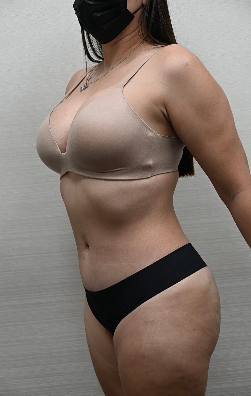 Abdominoplastia Before & After
