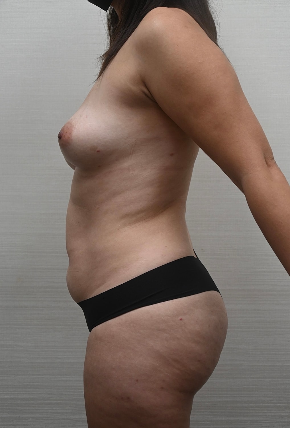 Abdominoplastia Before & After