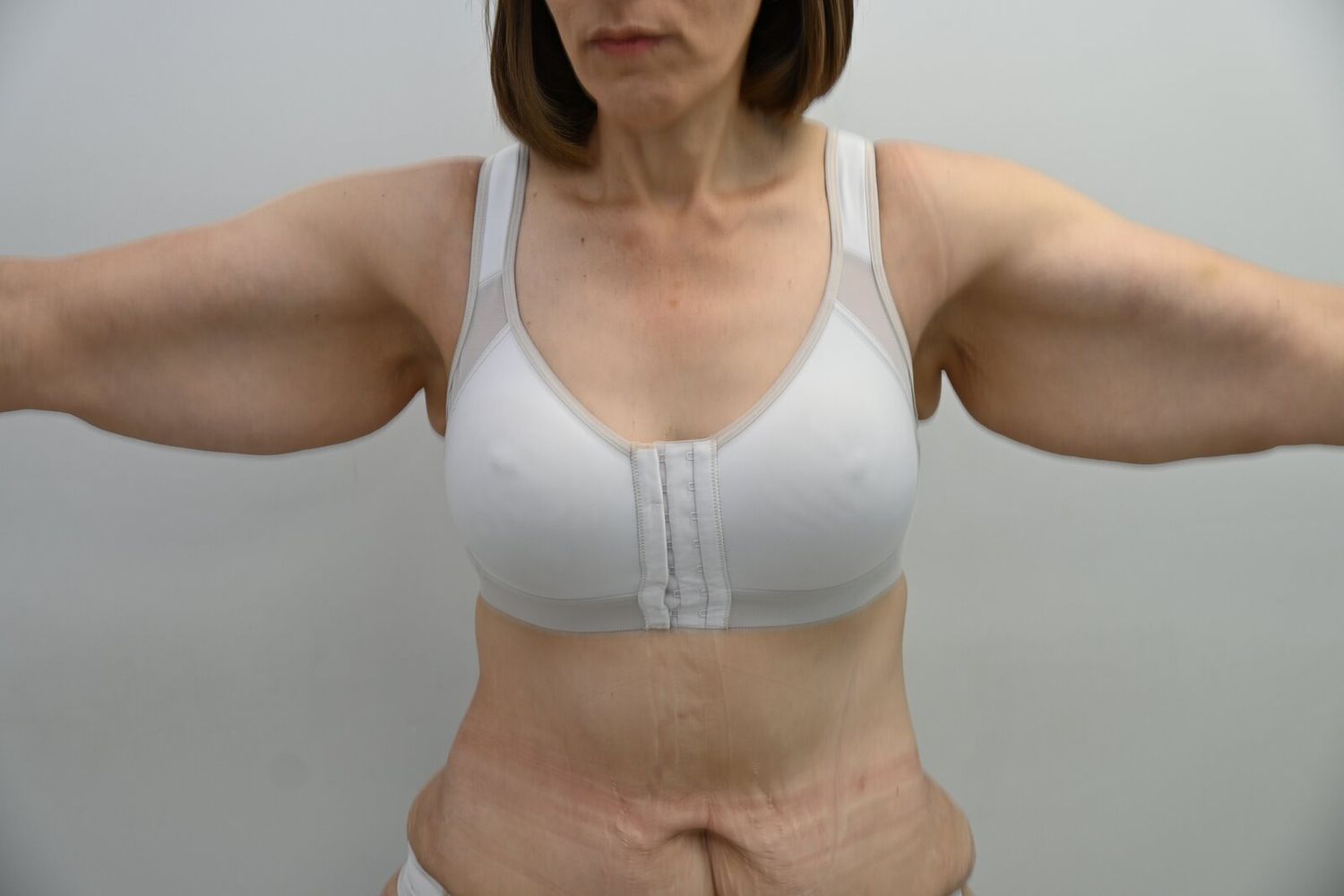 Braquioplastia Before & After