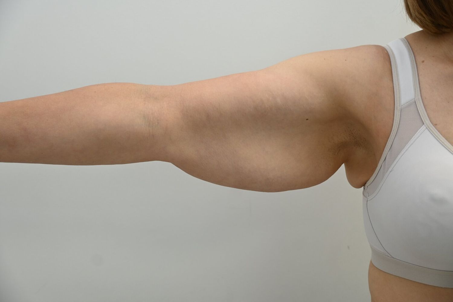 Braquioplastia Before & After