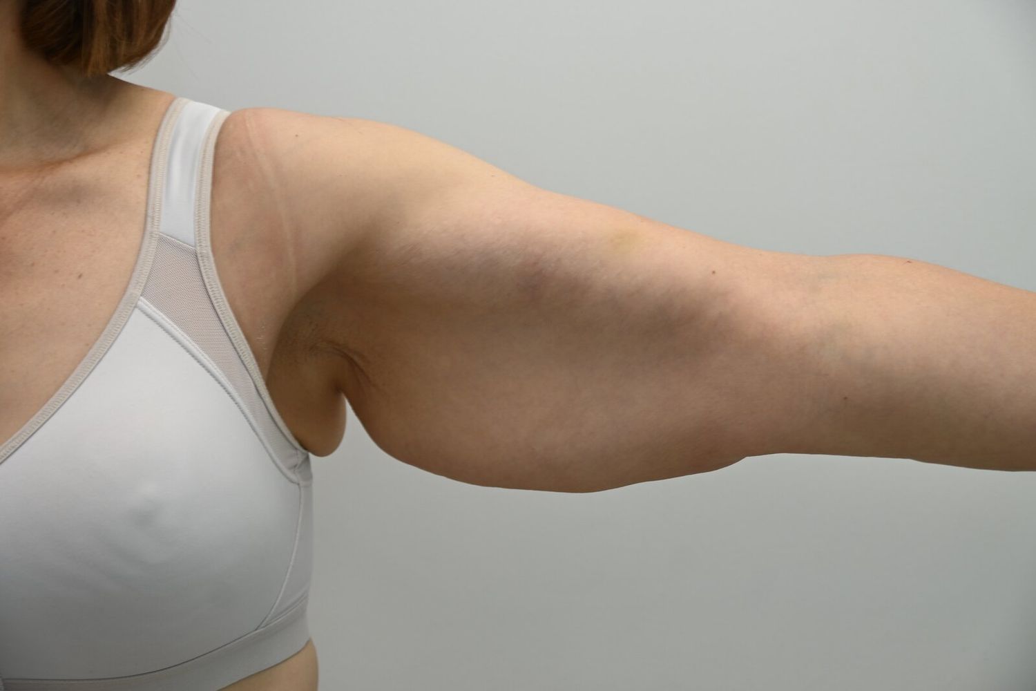 Braquioplastia Before & After