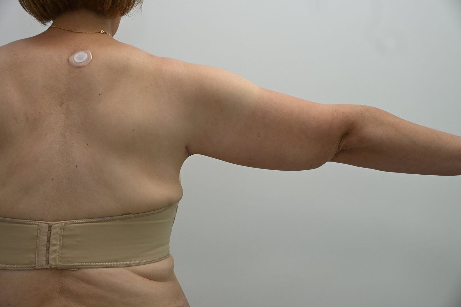 Braquioplastia Before & After