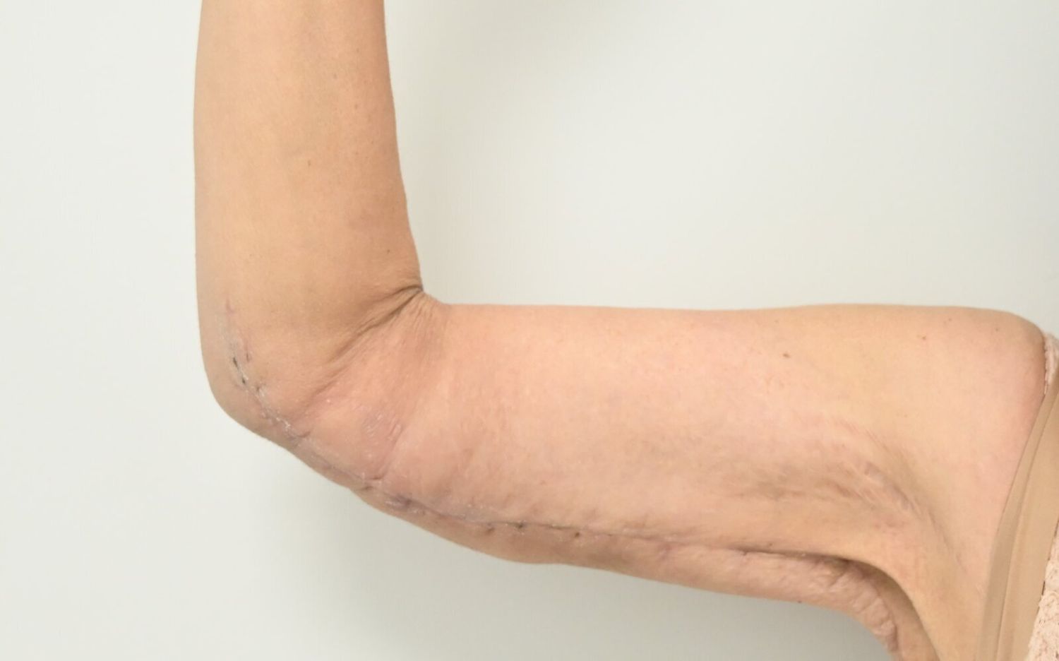 Braquioplastia Before & After