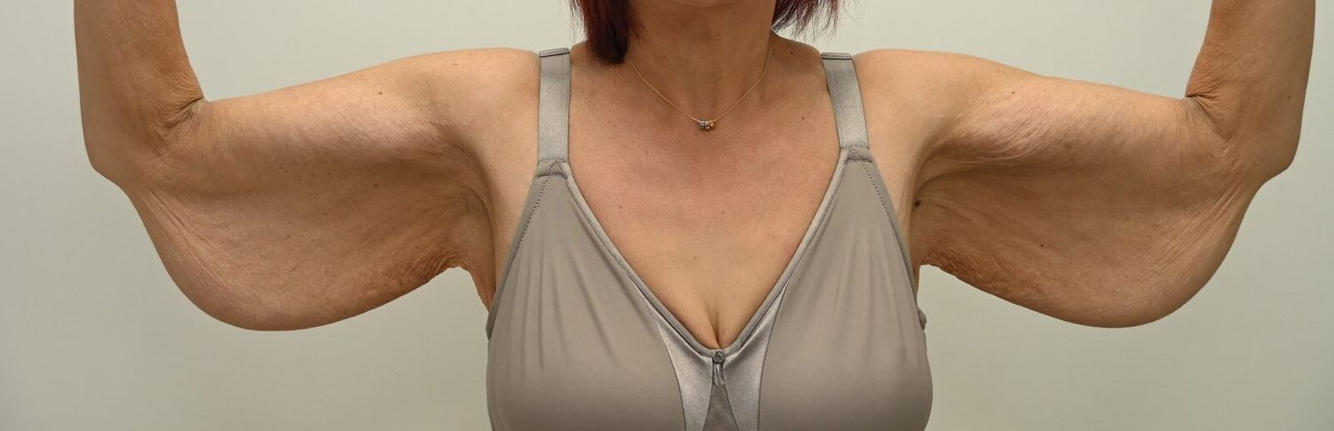 Braquioplastia Before & After