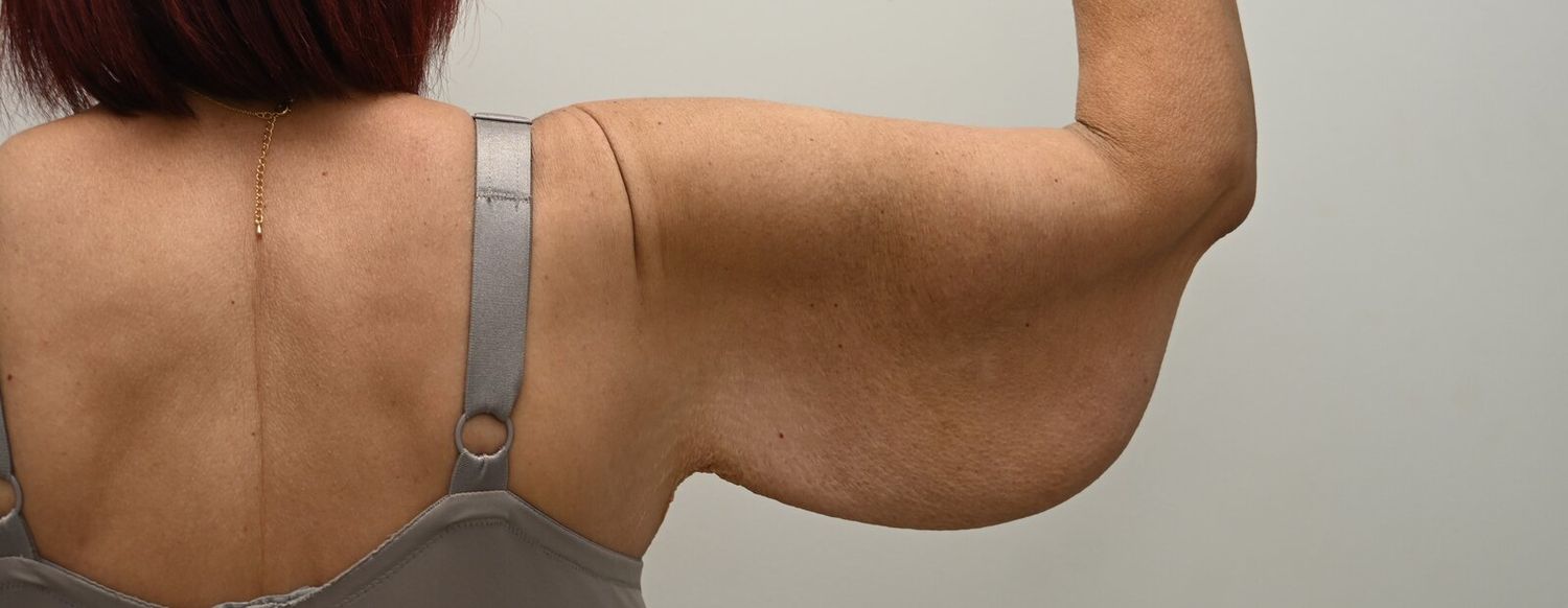 Braquioplastia Before & After