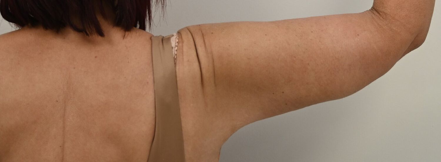 Braquioplastia Before & After