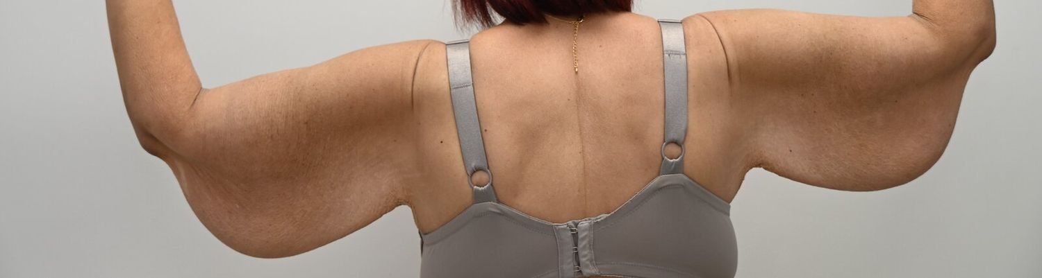 Braquioplastia Before & After