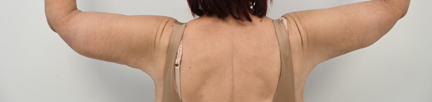 Braquioplastia Before & After