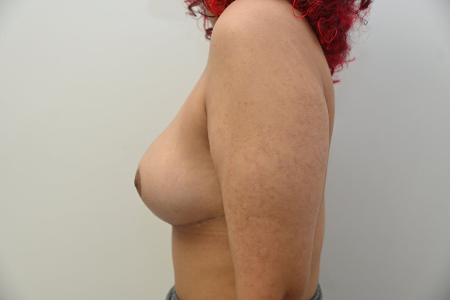 Reduccion De Senos Before & After