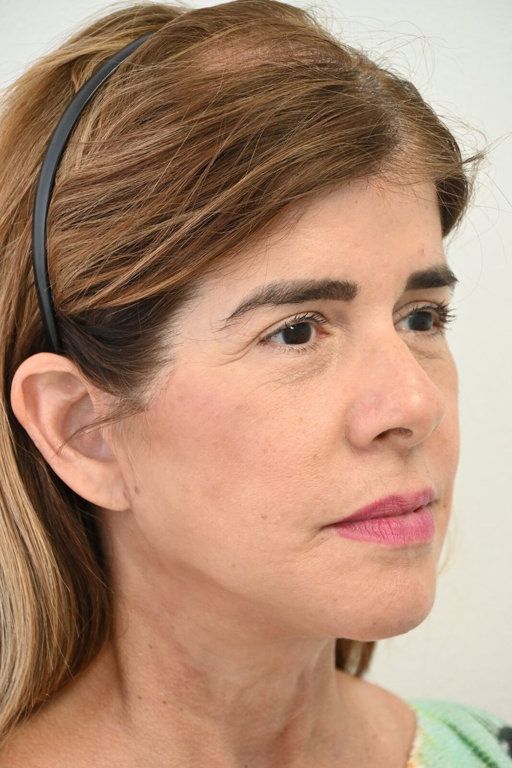 Estiramiento Facial Before & After