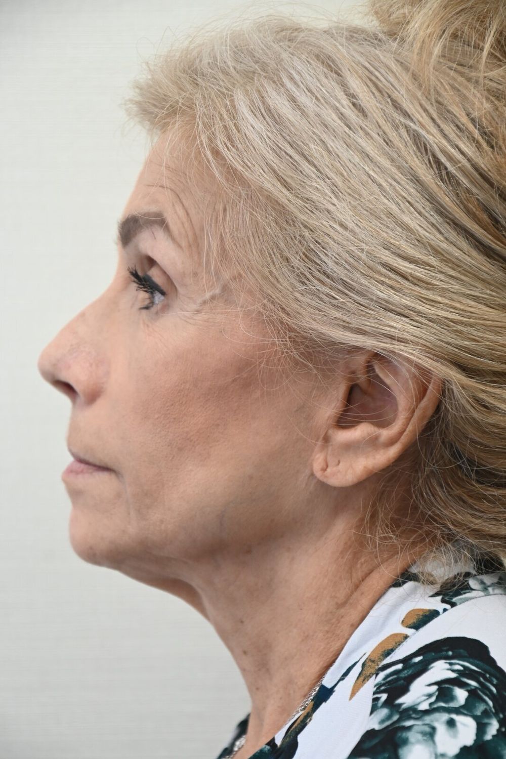 Estiramiento Facial Before & After