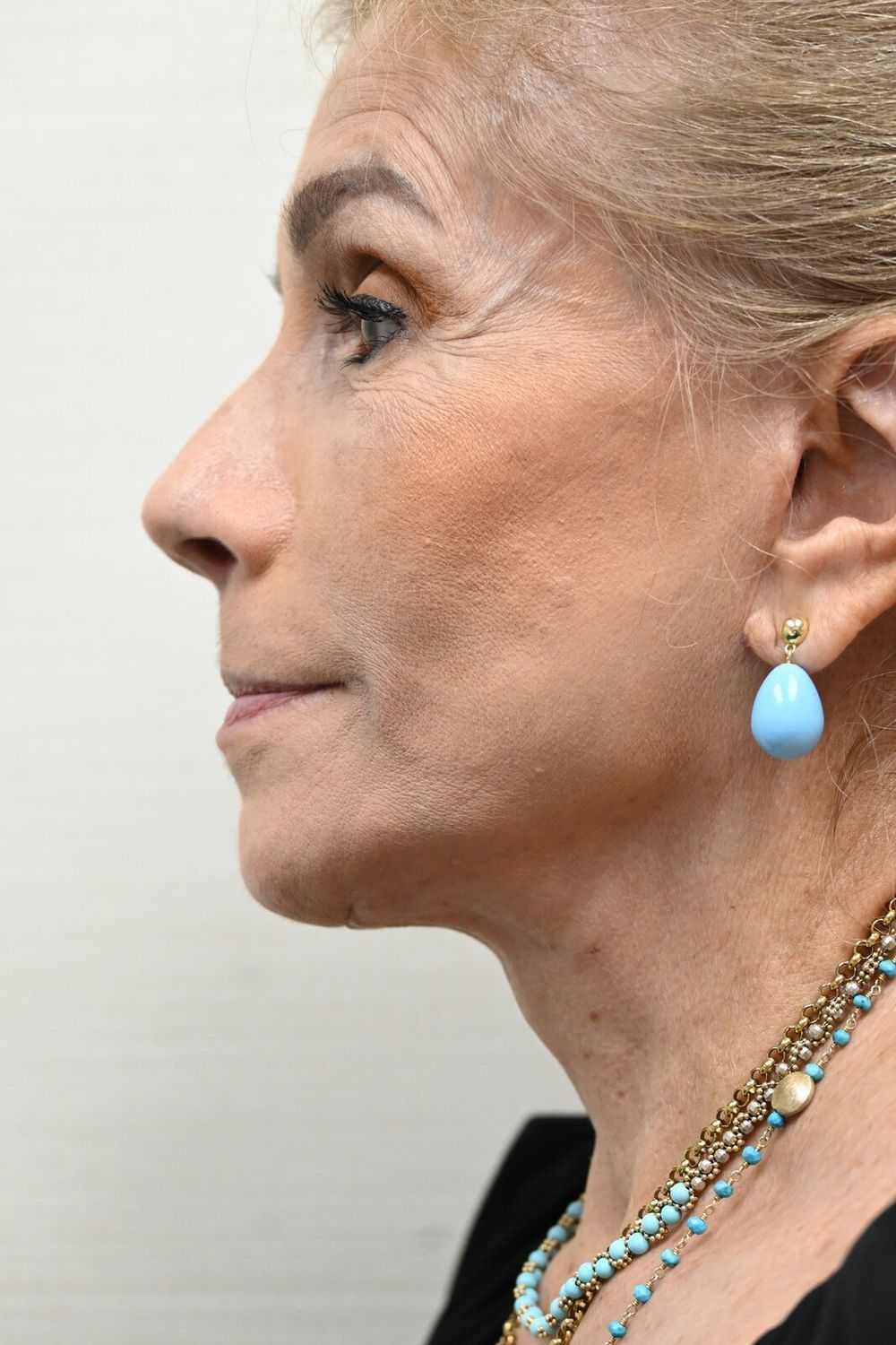 Estiramiento Facial Before & After