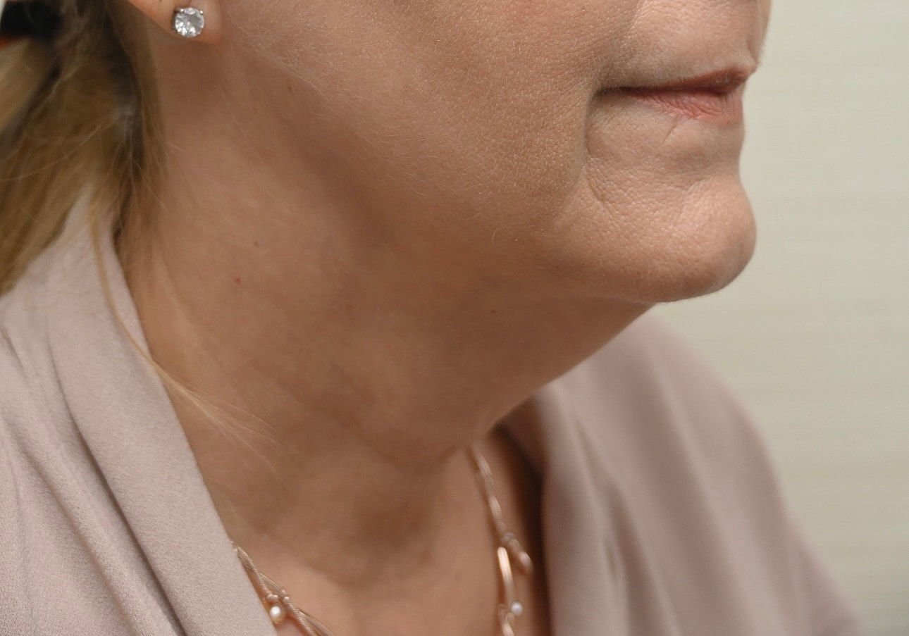 Estiramiento Facial Before & After