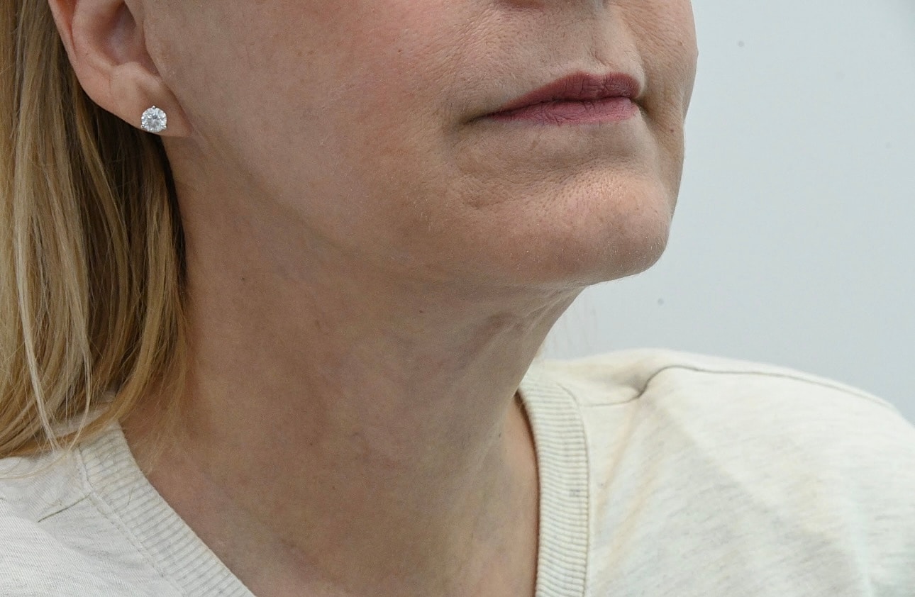 Estiramiento Facial Before & After