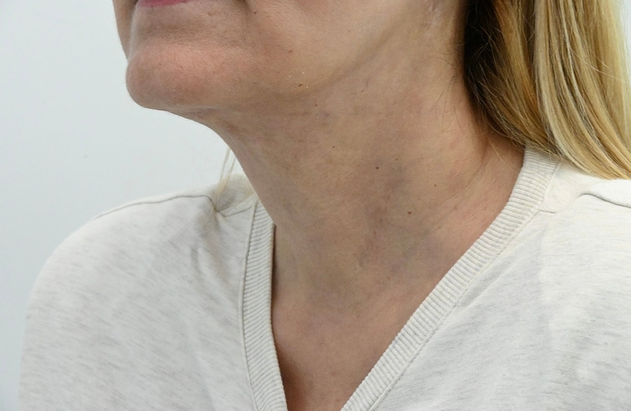 Estiramiento Facial Before & After