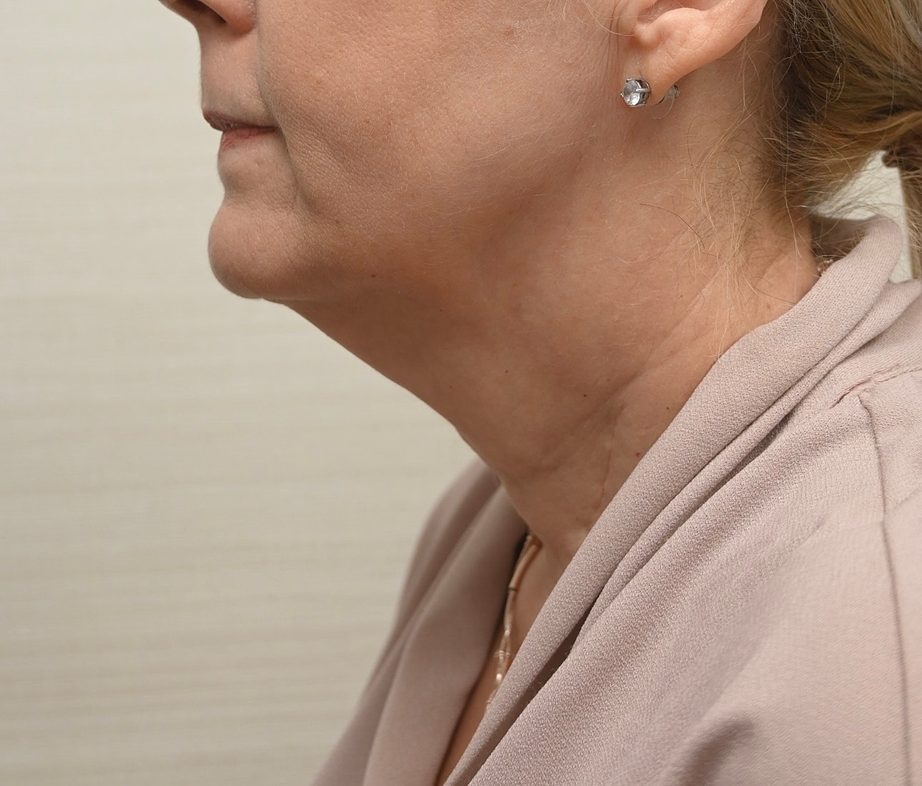 Estiramiento Facial Before & After