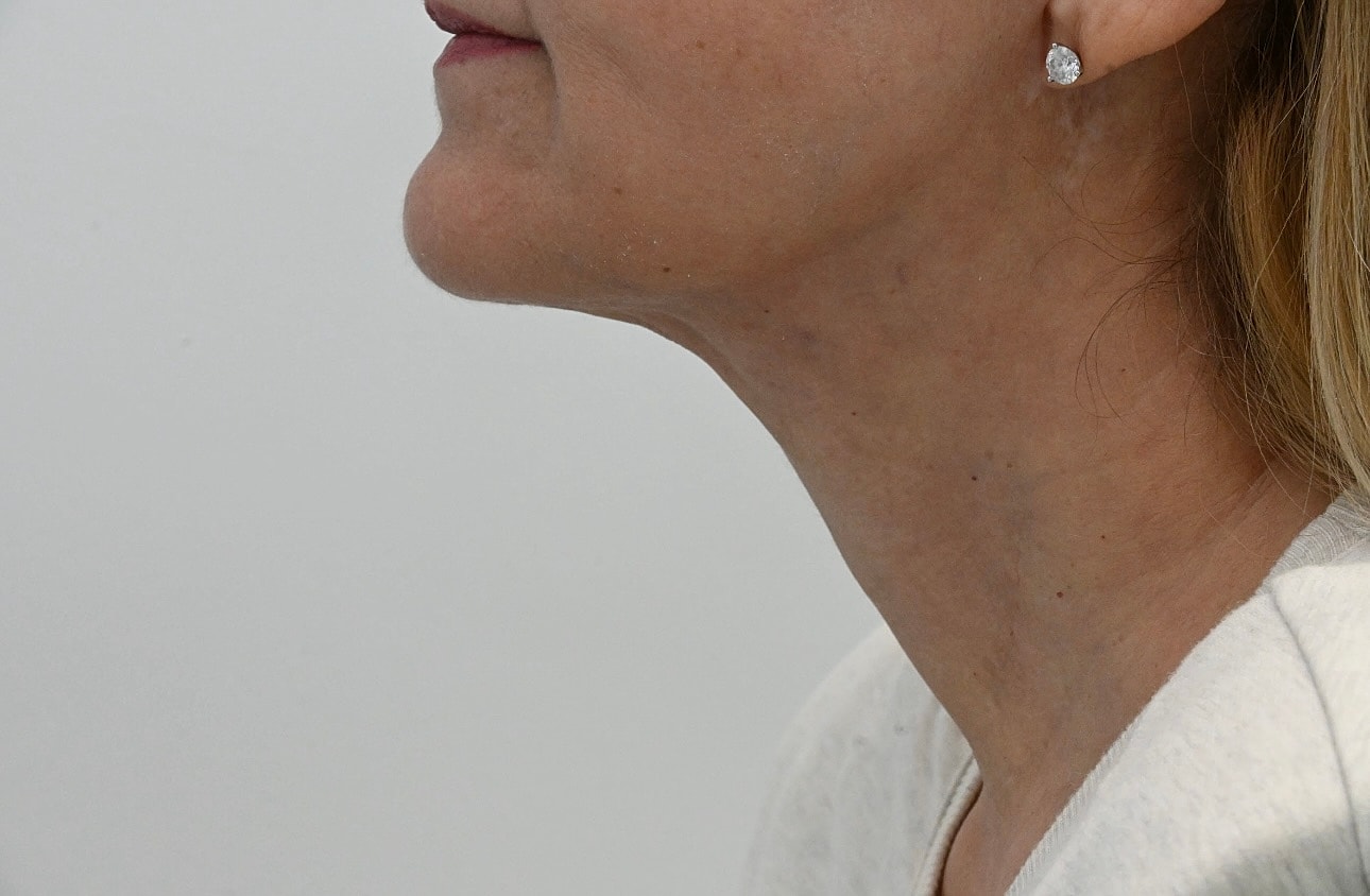 Estiramiento Facial Before & After