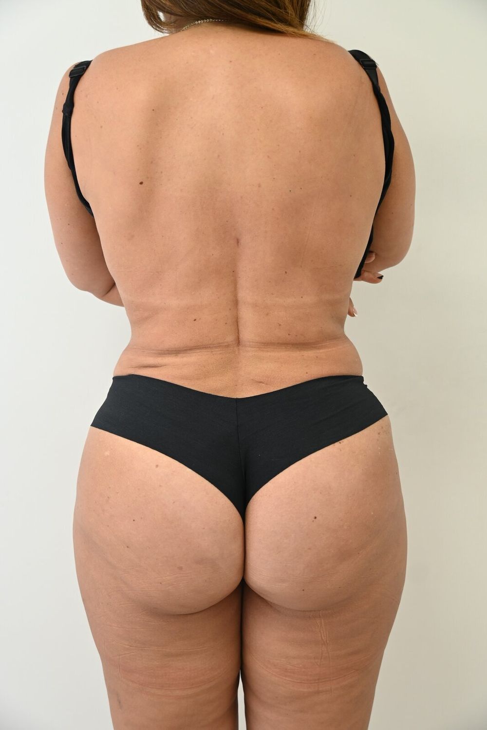 Liposuccion Espalda Before & After