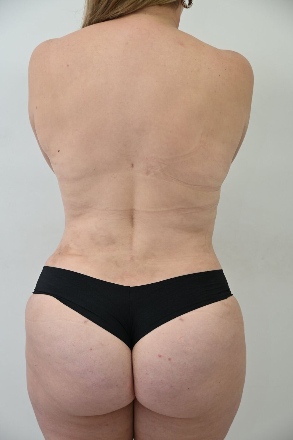 Liposuccion Espalda Before & After