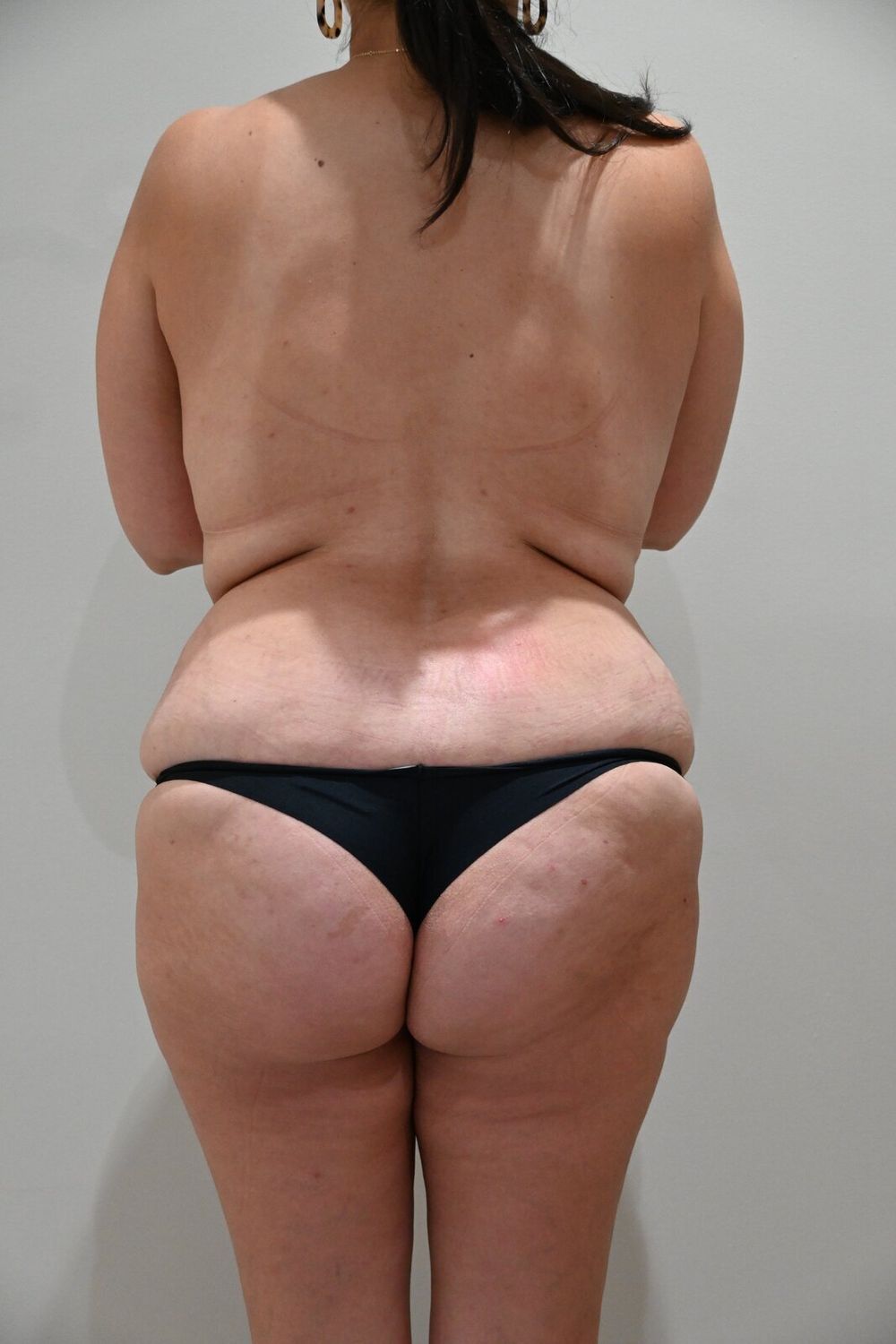 Liposuccion Espalda Before & After