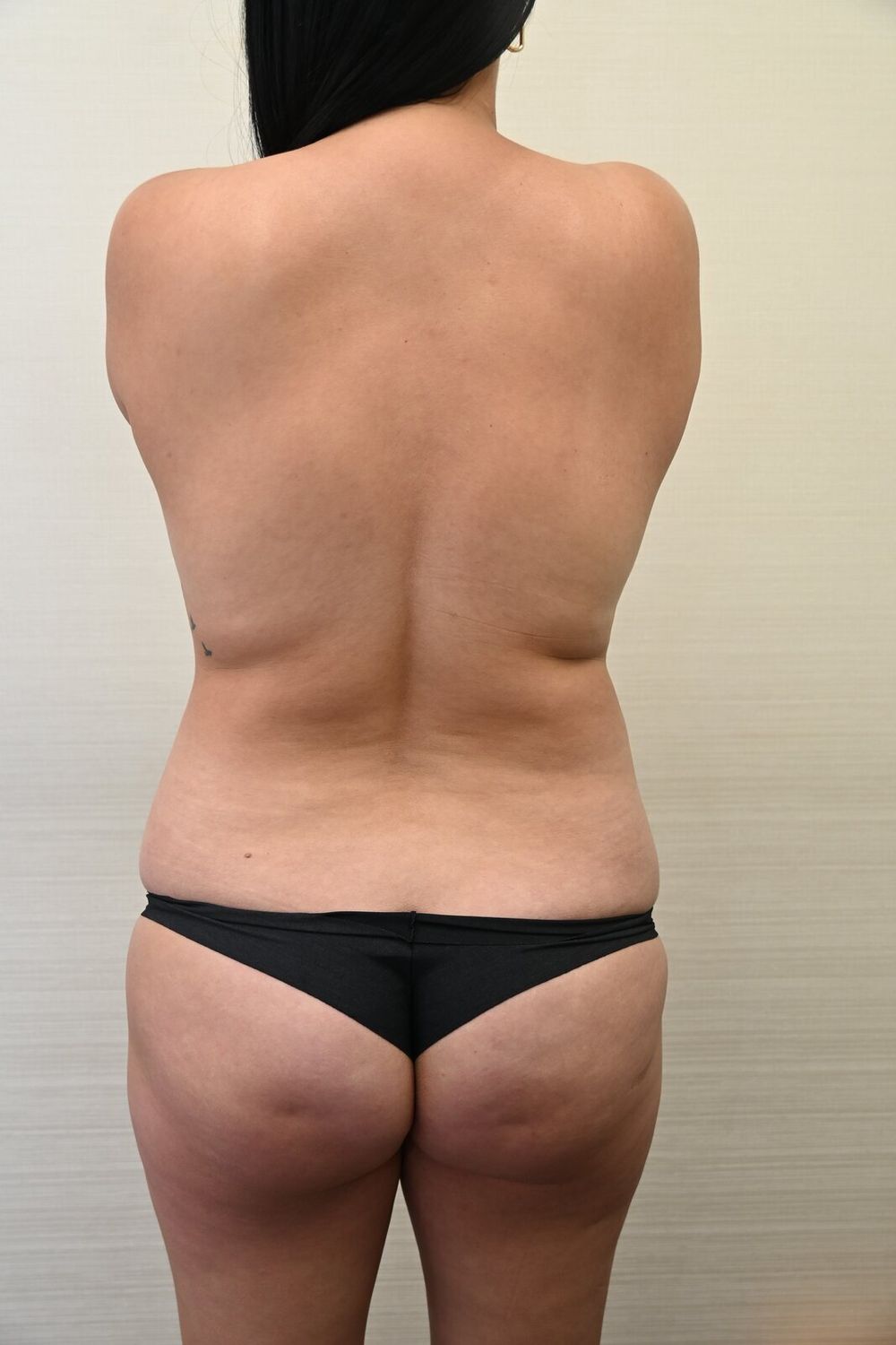 Liposuccion Espalda Before & After