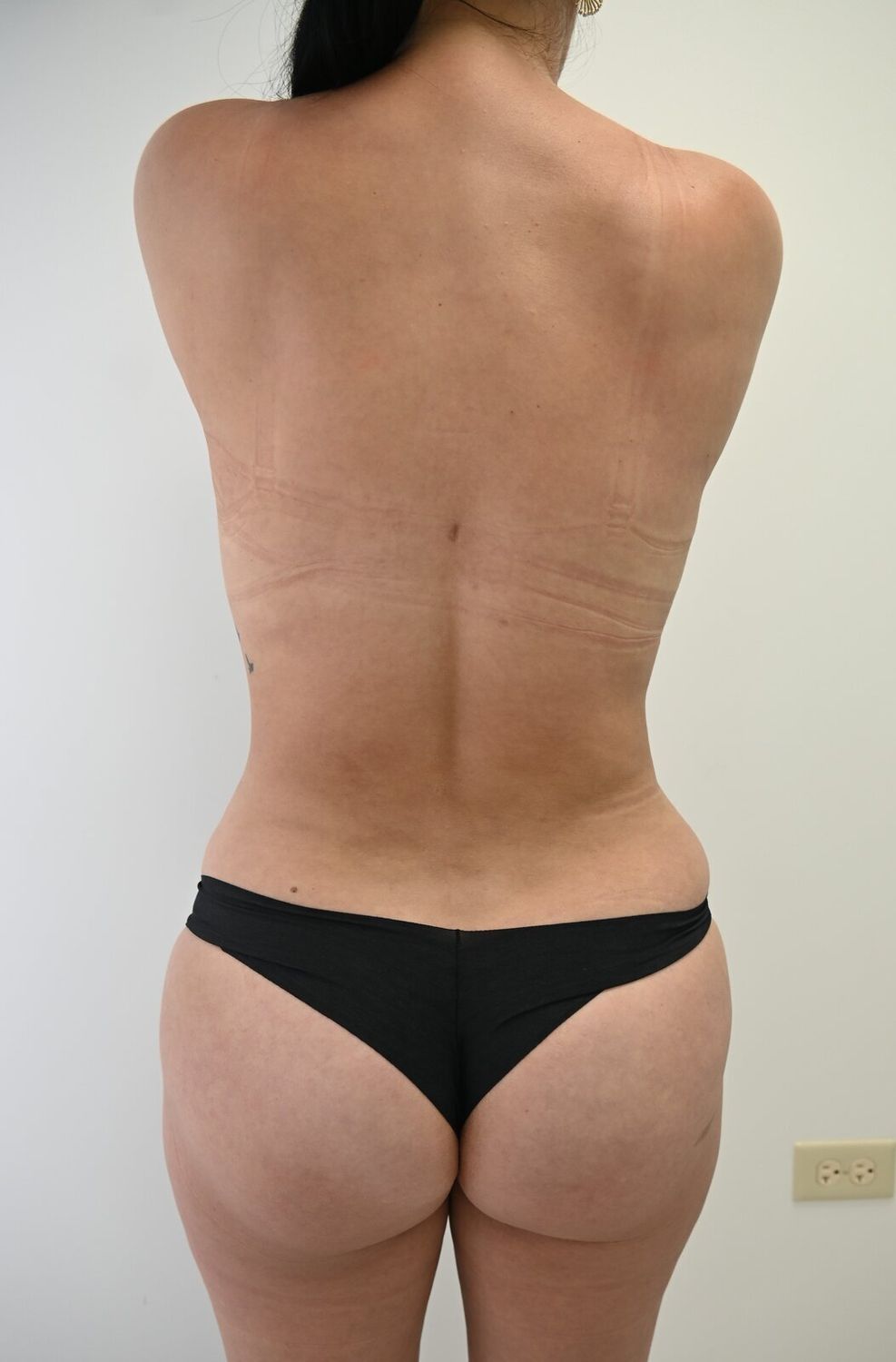 Liposuccion Espalda Before & After