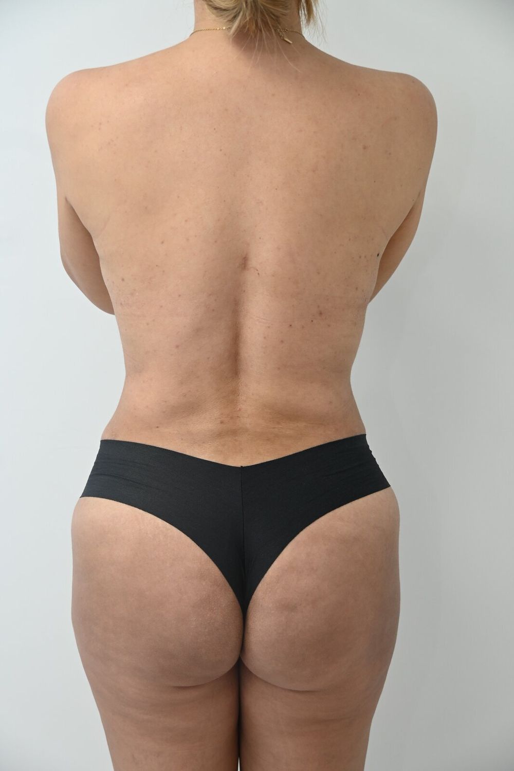 Liposuccion Espalda Before & After