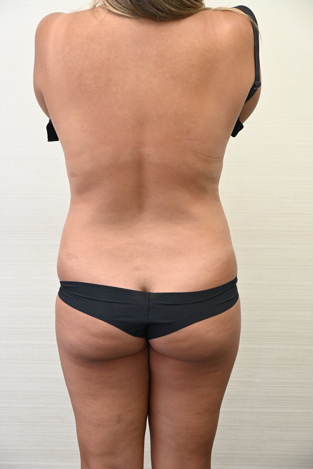 Liposuccion Espalda Before & After