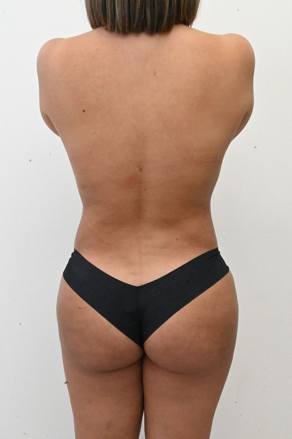 Liposuccion Espalda Before & After