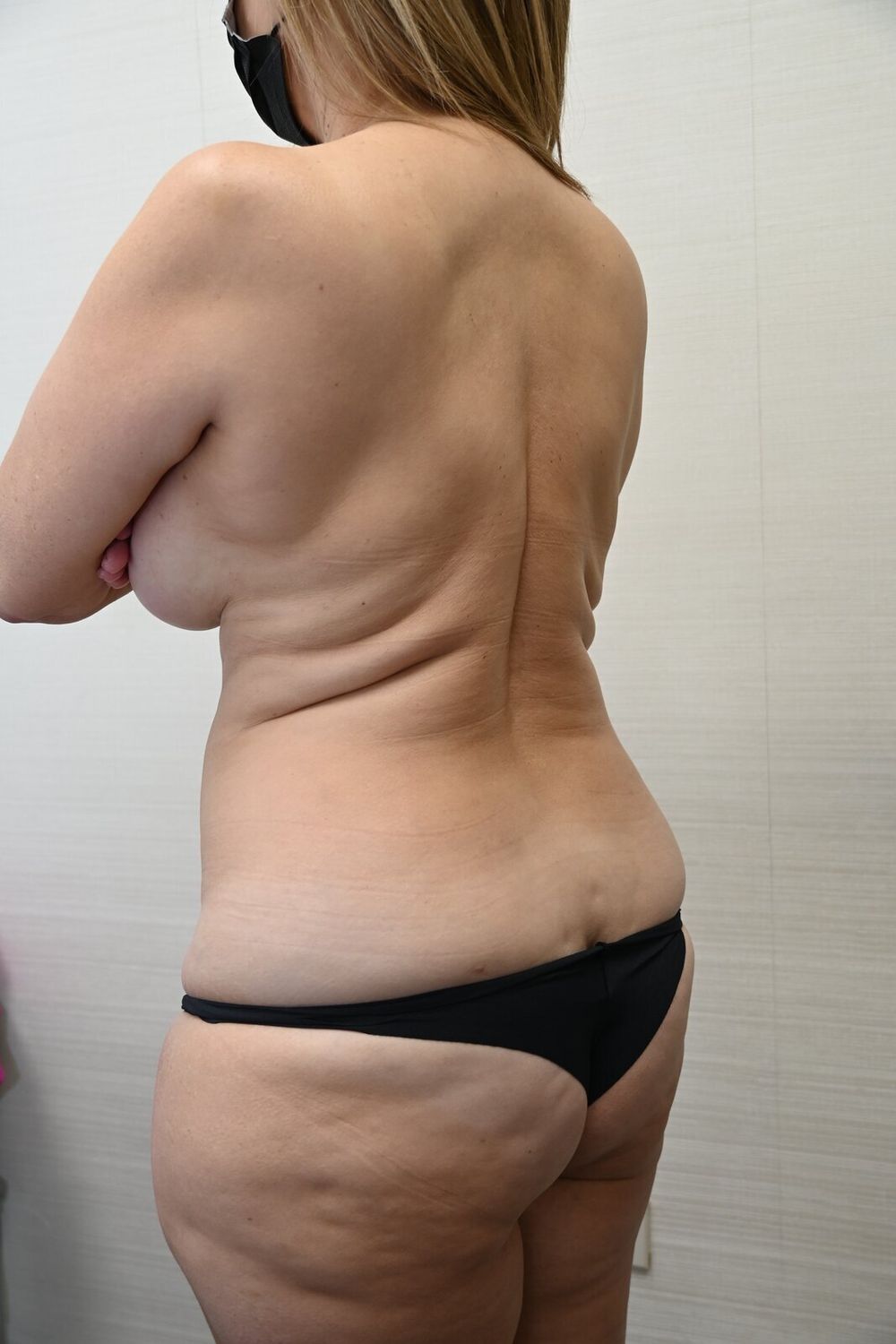 Liposuccion Espalda Before & After