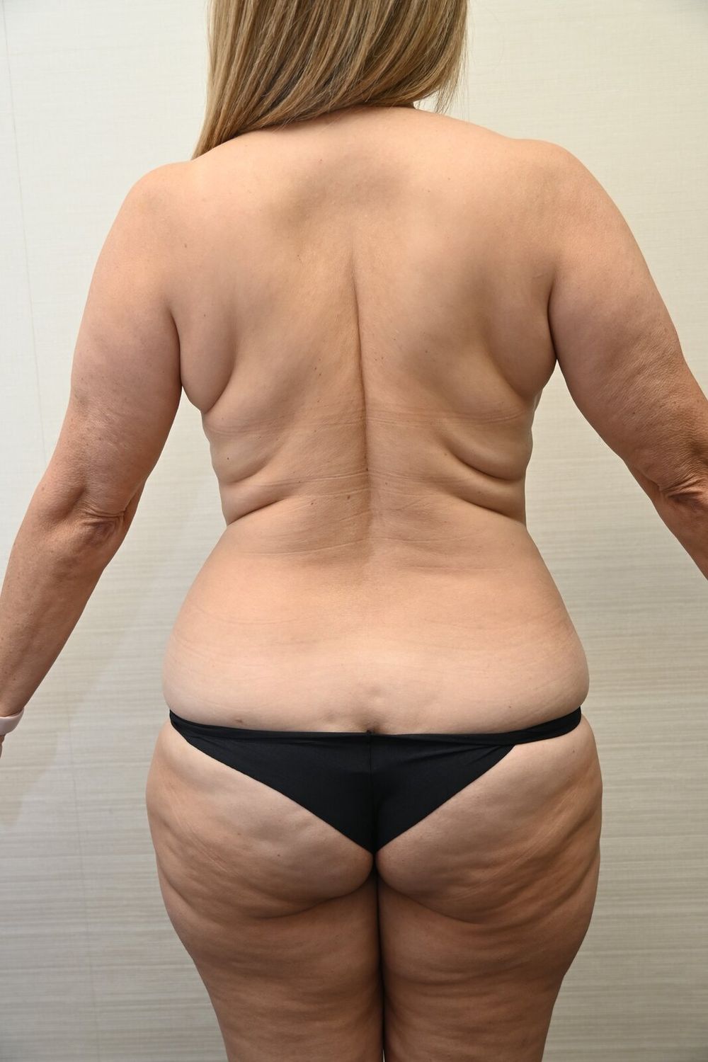 Liposuccion Espalda Before & After