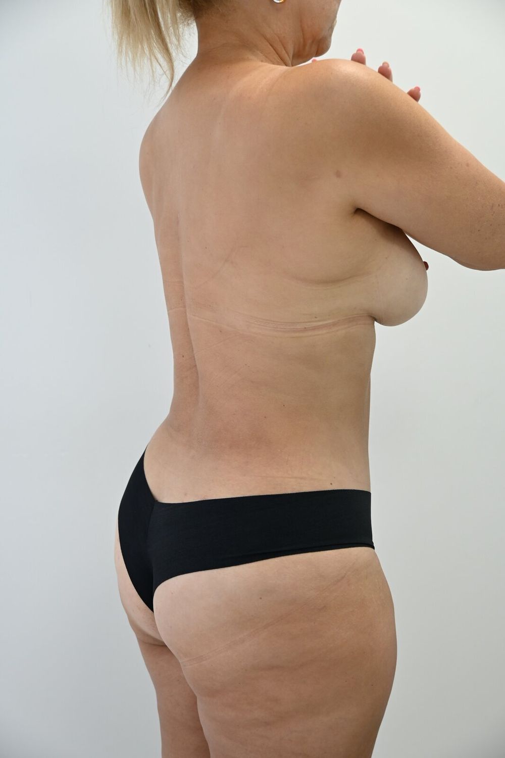 Liposuccion Espalda Before & After