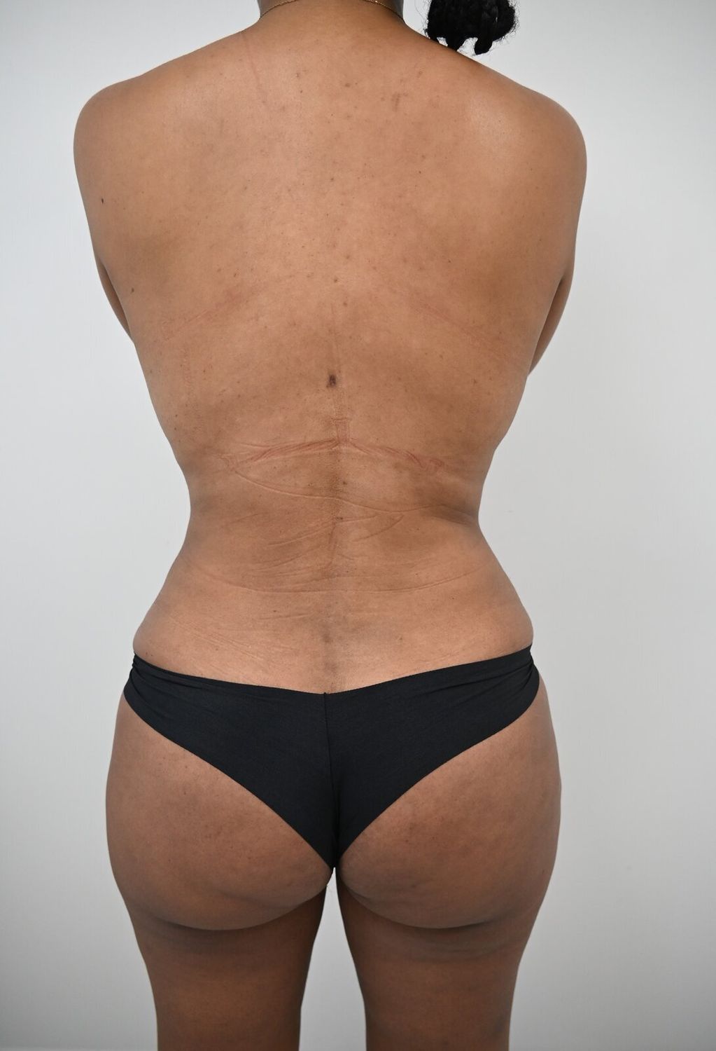 Liposuccion Espalda Before & After